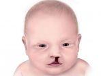 ilustrasi-bayi-yang-mengalami-bibir-sumbing.jpg