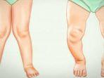 ilustrasi-bentuk-kaki-x-dan-o.jpg