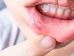 ilustrasi-bentuk-stomatitis-aphtosa-rekuren-minor.jpg