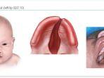 ilustrasi-bibir-sumbinng.jpg