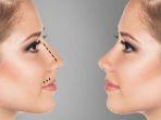 ilustrasi-botox-cuping-hidung.jpg