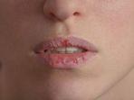 ilustrasi-cincin-merah-diseputar-bibir.jpg