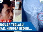 ilustrasi-dislokasi-sendi-rahang-akibat-menguap-terlalu-lebar.jpg