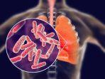 ilustrasi-gambaran-tuberkulosis-paru-begini-penjelasan.jpg