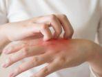ilustrasi-gejala-dermatitis-atopik.jpg