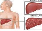 ilustrasi-gejala-gangguan-liver-atau-hati.jpg