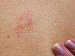 ilustrasi-gejala-herpes.jpg