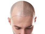 ilustrasi-hair-tranplantation.jpg