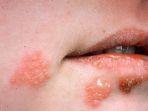 ilustrasi-herpes-di-wajah-begini-ulasan.jpg