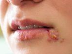 ilustrasi-herpes-labialis.jpg