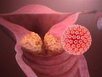 ilustrasi-human-papillomavirus-hpv.jpg
