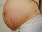 ilustrasi-ibu-hamil-rentan-mengalami-stretch-mark.jpg