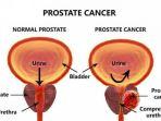 ilustrasi-kanker-prostat-yang-dialami-pria.jpg