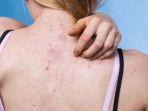 ilustrasi-karakteristik-back-acne-atau-jerawat-punggung.jpg