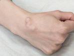 ilustrasi-kista-ganglion-a.jpg