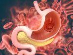 ilustrasi-kondisi-lambung-penderita-maag.jpg