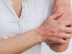 ilustrasi-kulit-bersisik-akibat-psoriasis.jpg