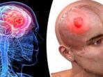 ilustrasi-letak-tumor-otak.jpg