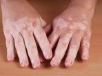ilustrasi-mengalami-vitiligo-di-usia-dewasa.jpg