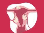 ilustrasi-mioma-uteri-wanita.jpg