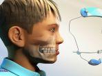 ilustrasi-pemasangan-reverse-pull-headgear-atau-facemask.jpg