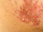 ilustrasi-penampakkan-penyakit-herpes-begini-ulaan.jpg