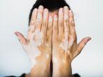 ilustrasi-penderita-vitiligo-di-bagian-tangan.jpg