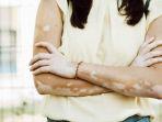 ilustrasi-penderita-vitiligo-sejak-usia-muda.jpg