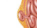 ilustrasi-pengidap-hernia.jpg