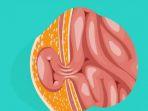 ilustrasi-penyakit-hernia.jpg