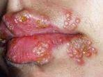 ilustrasi-penyakit-herpes-labialis-yang-menyerang-area-bibir-hingga-hidung.jpg