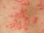 ilustrasi-penyakit-herpes-yang-menyebar.jpg