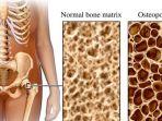 ilustrasi-penyakit-osteoporosis.jpg