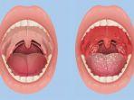 ilustrasi-penyakit-tonsilitis-atau-amandel.jpg