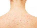 ilustrasi-penyebab-jerawat-punggung-atau-back-acne.jpg