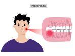 ilustrasi-perikoronitis.jpg