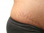 ilustrasi-pria-memiliki-stretch-mark.jpg