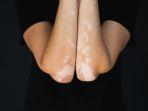 ilustrasi-pria-yang-mengalami-vitiligo.jpg