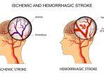 ilustrasi-seseorang-alami-stroke-di-usia-muda.jpg