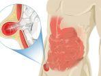 ilustrasi-seseorang-menderita-hernia.jpg
