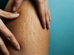 ilustrasi-stretch-mark-akibat-kenaikan-berat-badan.jpg