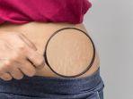ilustrasi-stretch-mark-di-perut.jpg