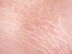 ilustrasi-stretch-mark-pada-pria.jpg