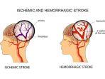 ilustrasi-stroke-iskemik.jpg