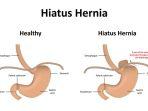 ilustrasi-terjadinya-hernia.jpg