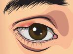 ilustrasi-terjadinya-mata-bintitan.jpg