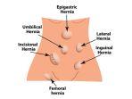 ilustrasi-ukuran-hernia.jpg