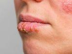 ilustrasi-virus-herpes-begini-penuturan.jpg