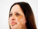 ilustrasi-vitiligo-yang-nampak-pada-wajah.jpg