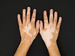 ilustrasi-vitiligo-yang-tampak-pada-tangan.jpg